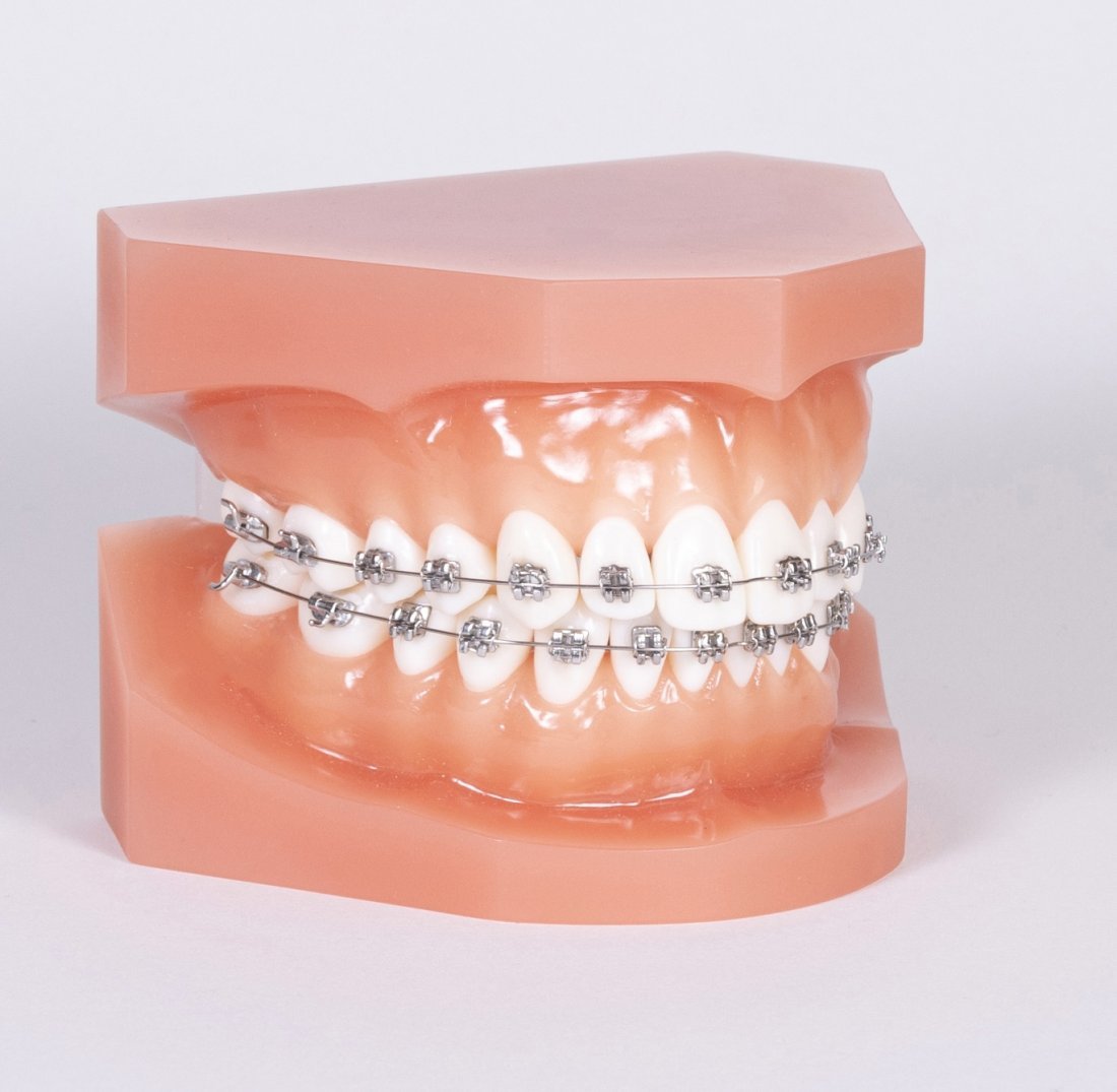 Zubní rovnátka cena, ceny rovnátek | Perfect Smile s.r.o. Praha